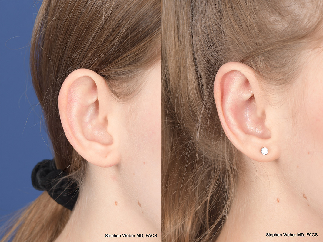 Otoplasty Before and After | Weber Facial Plastic Surgery