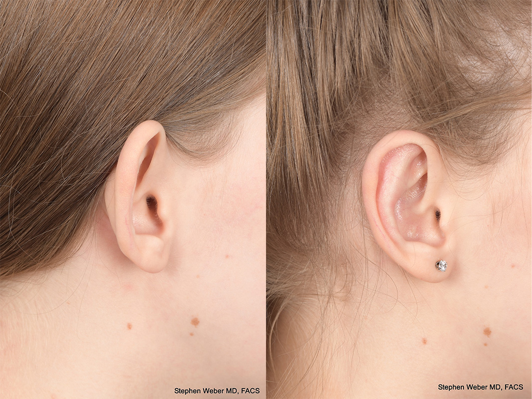 Otoplasty Before and After | Weber Facial Plastic Surgery