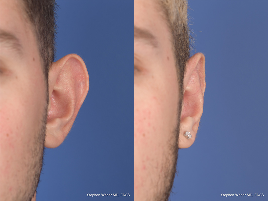 Otoplasty Before and After | Weber Facial Plastic Surgery
