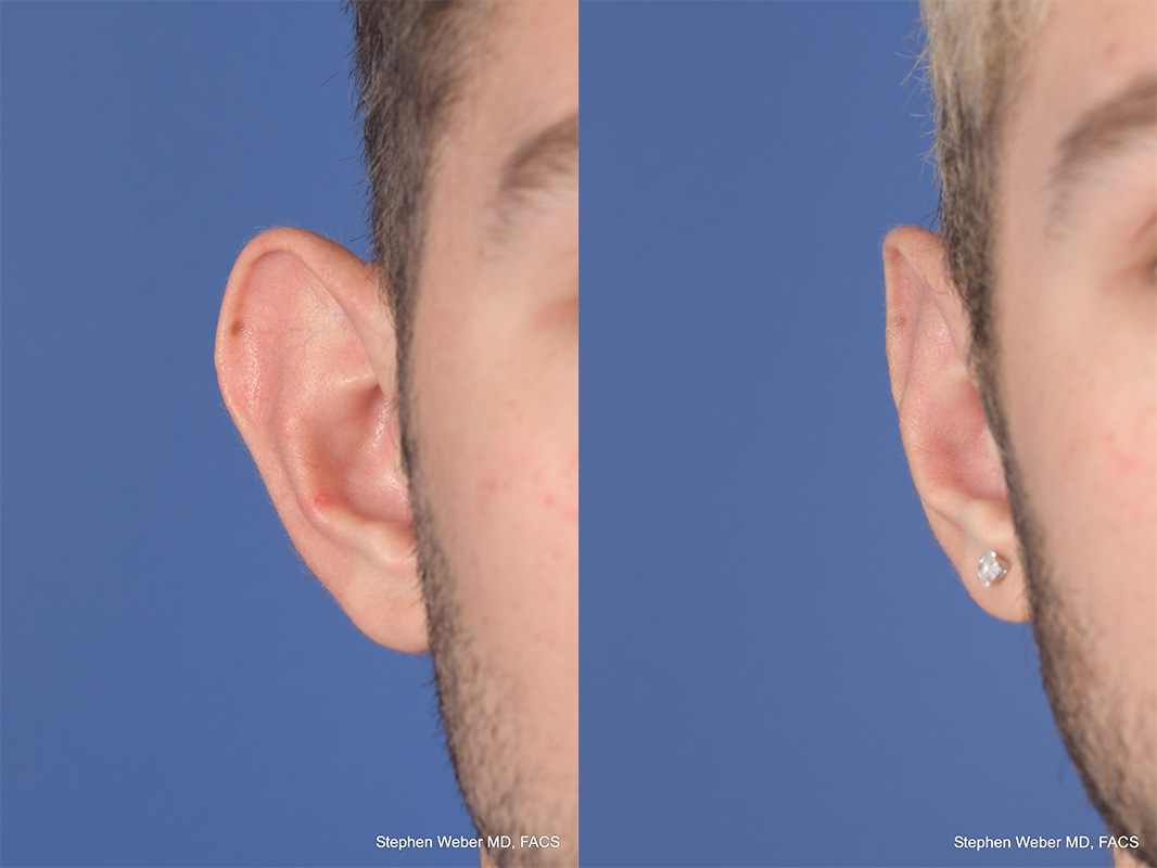 Otoplasty Before and After | Weber Facial Plastic Surgery