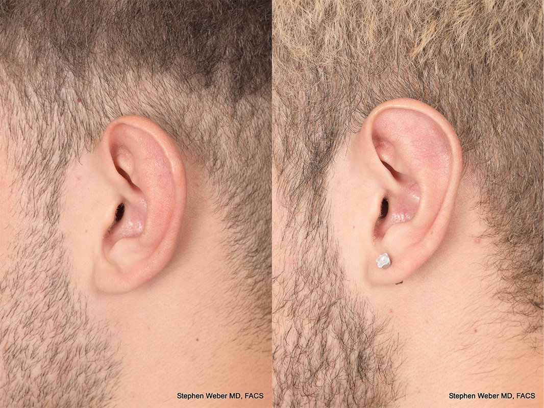 Otoplasty Before and After | Weber Facial Plastic Surgery