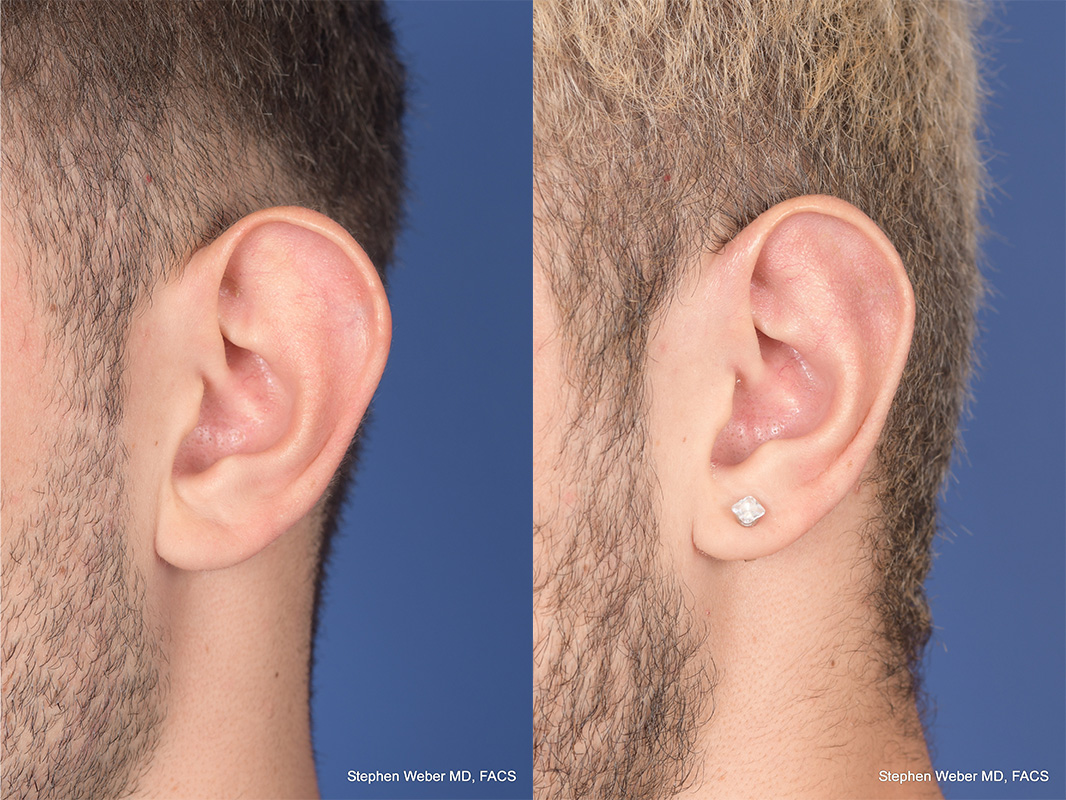 Otoplasty Before and After | Weber Facial Plastic Surgery