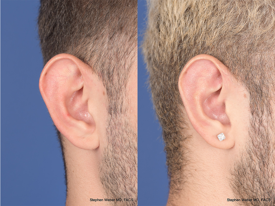 Otoplasty Before and After | Weber Facial Plastic Surgery