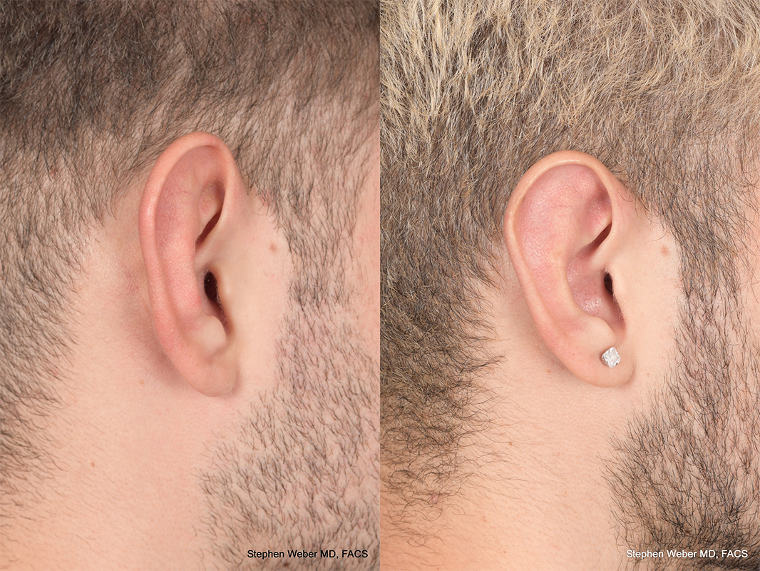 Otoplasty Before and After | Weber Facial Plastic Surgery