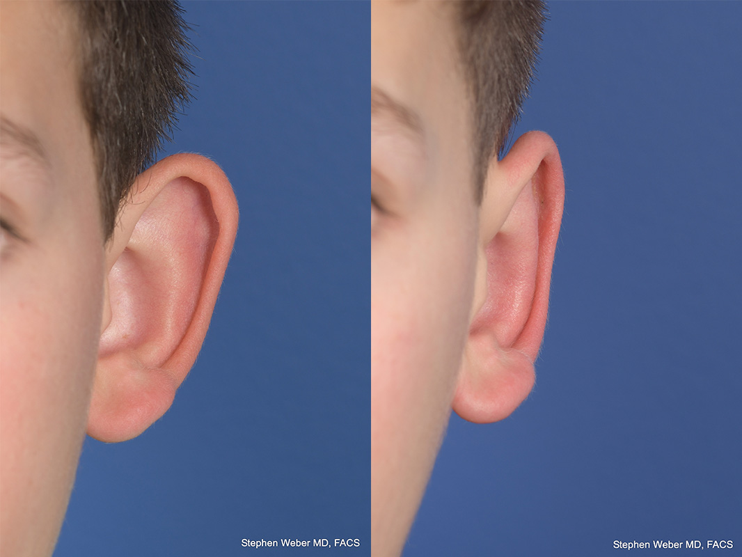 Otoplasty Before and After | Weber Facial Plastic Surgery