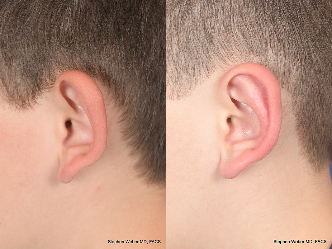 Otoplasty Before and After | Weber Facial Plastic Surgery