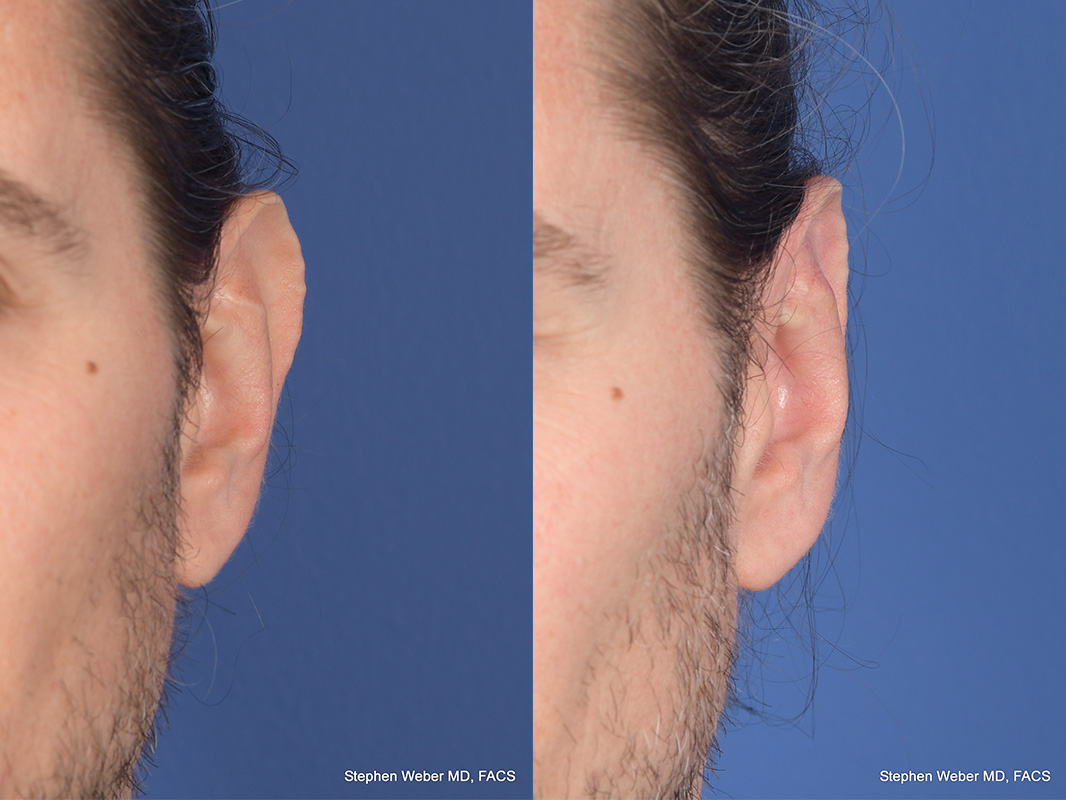 Otoplasty Before and After | Weber Facial Plastic Surgery