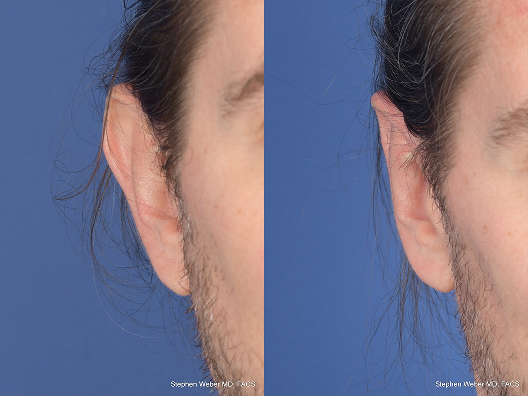 Otoplasty Before and After | Weber Facial Plastic Surgery