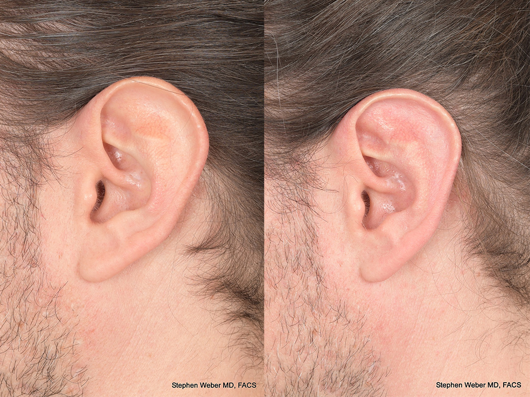 Otoplasty Before and After | Weber Facial Plastic Surgery
