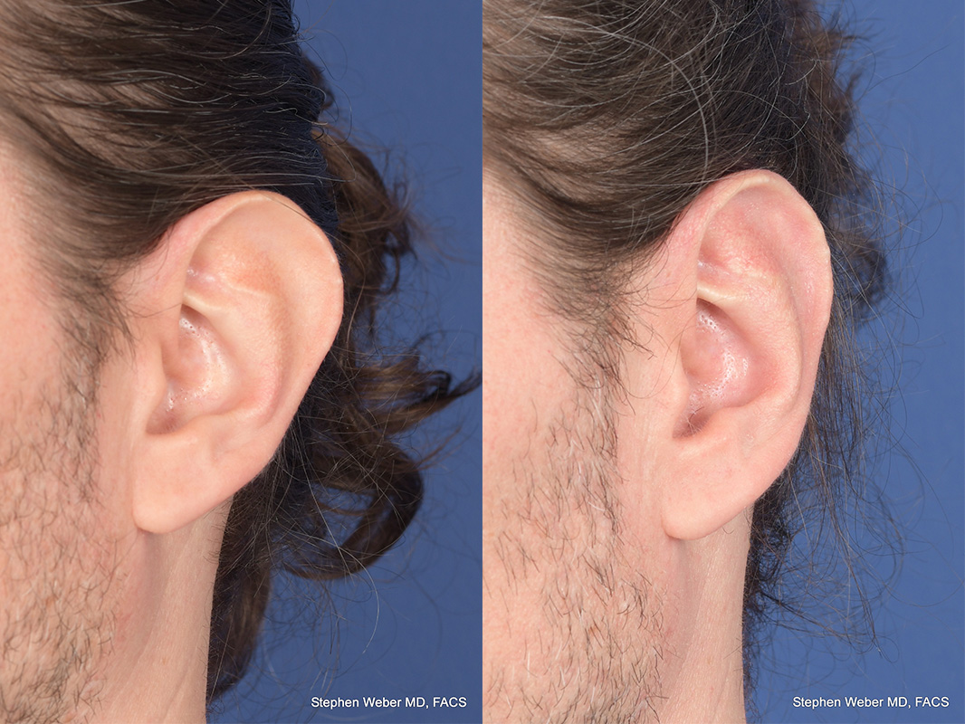 Otoplasty Before and After | Weber Facial Plastic Surgery