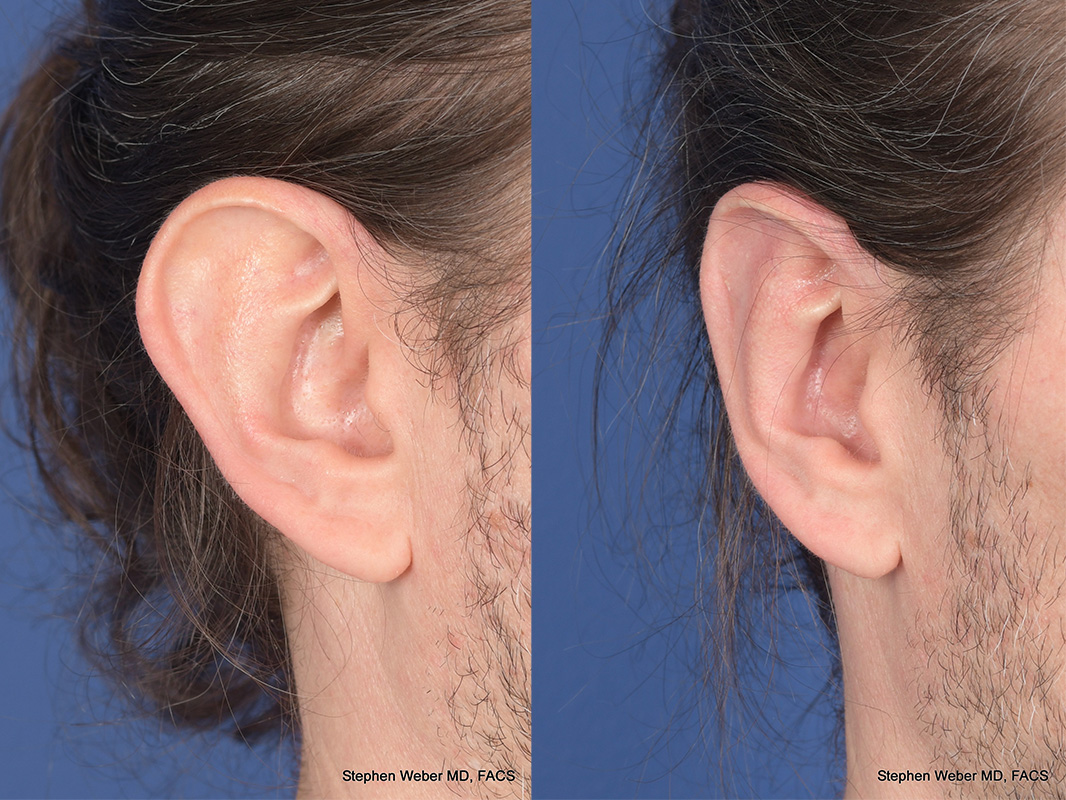 Otoplasty Before and After | Weber Facial Plastic Surgery