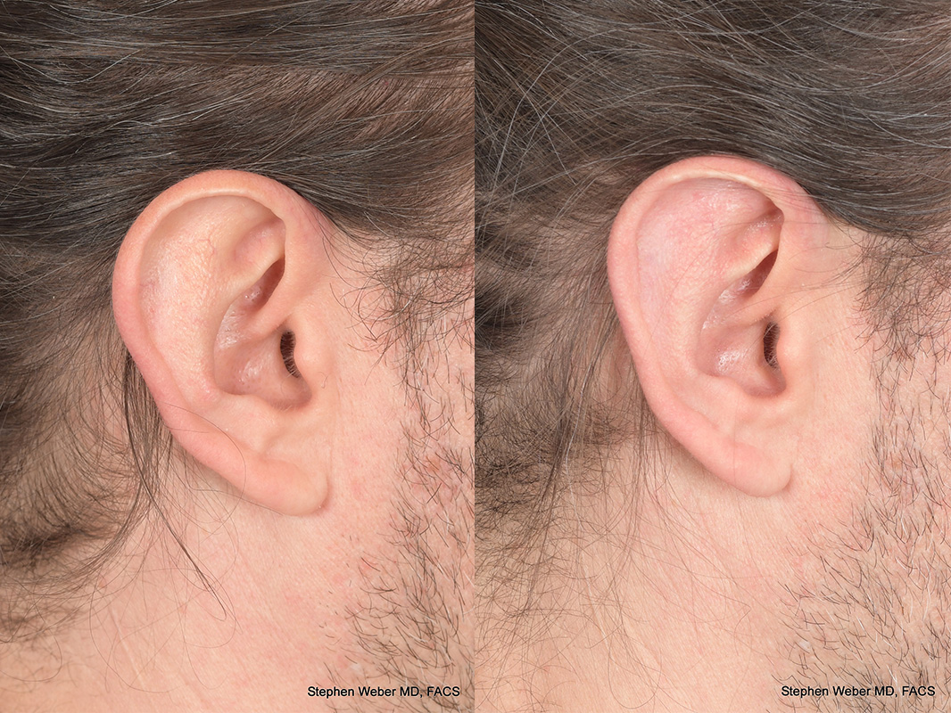 Otoplasty Before and After | Weber Facial Plastic Surgery