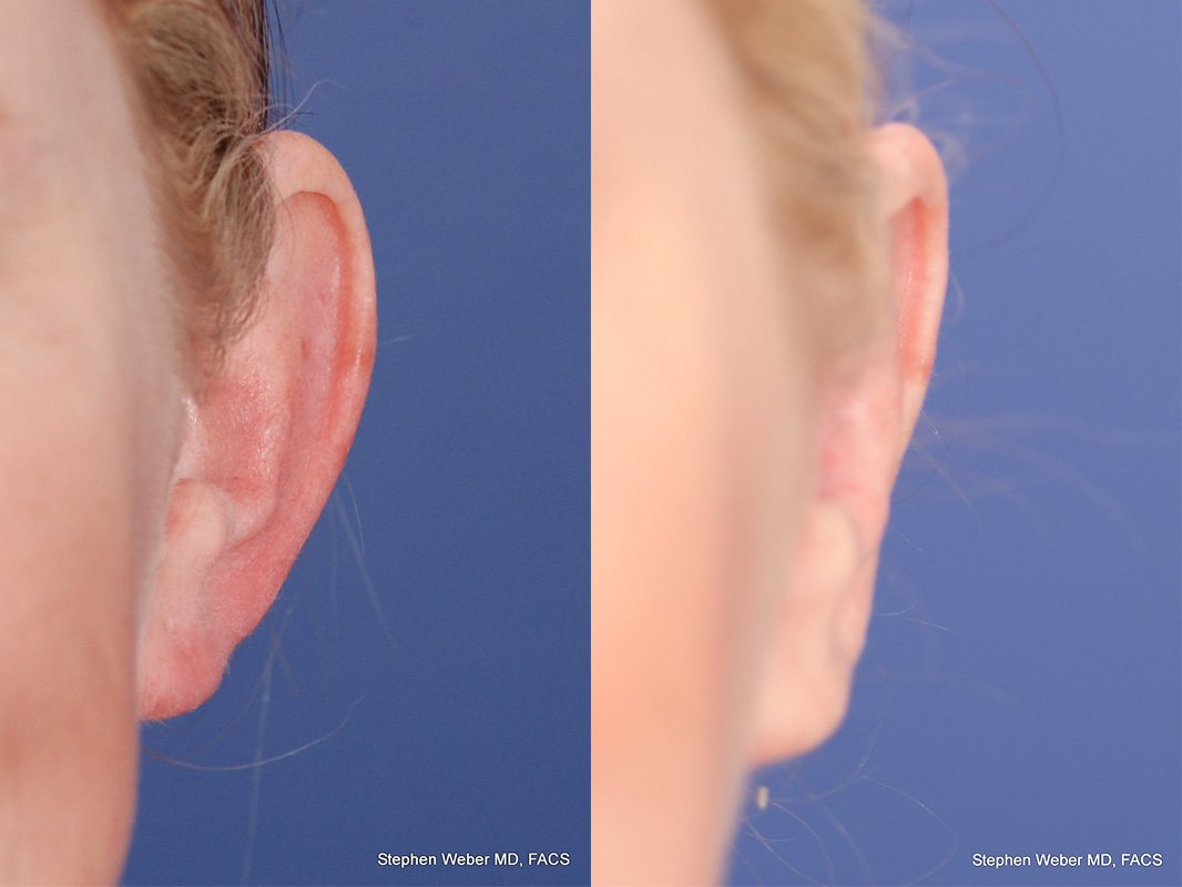 Otoplasty Before and After | Weber Facial Plastic Surgery