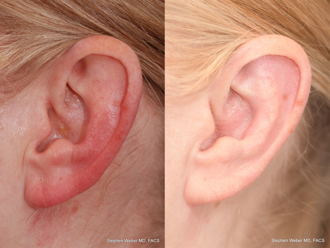 Otoplasty Before and After | Weber Facial Plastic Surgery