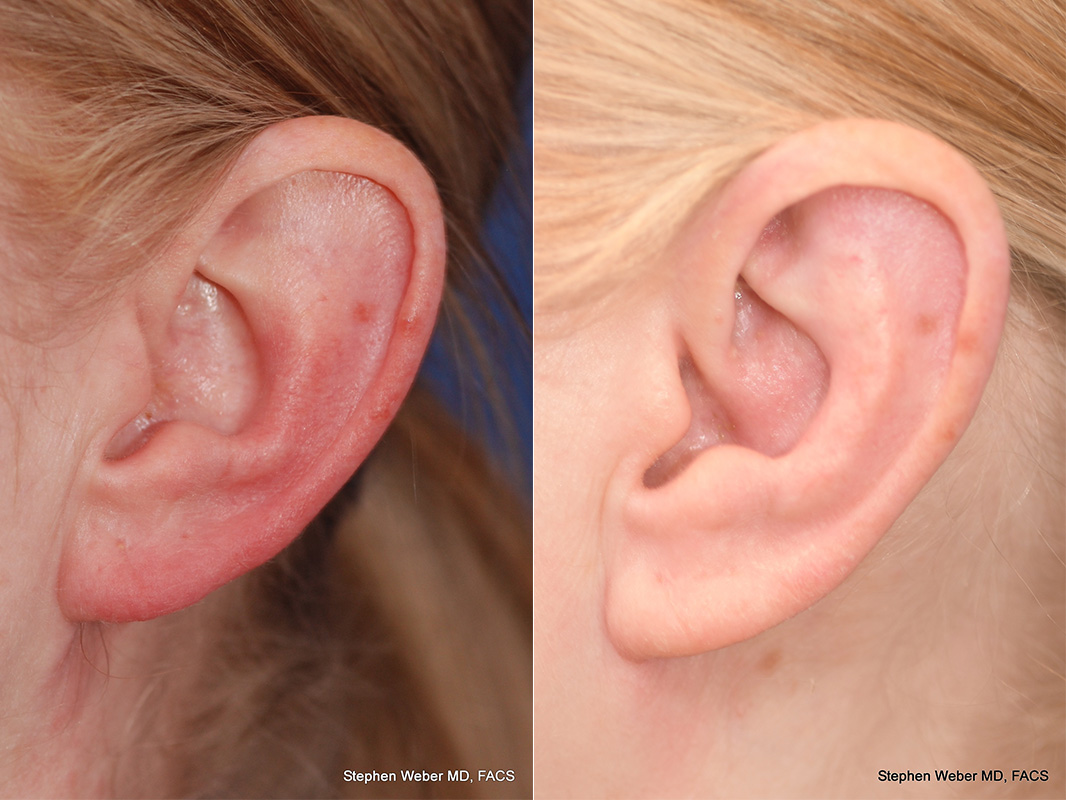 Otoplasty Before and After | Weber Facial Plastic Surgery