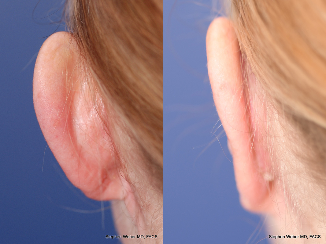 Otoplasty Before and After | Weber Facial Plastic Surgery