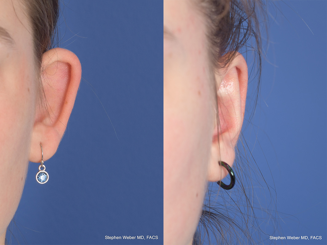 Otoplasty Before and After | Weber Facial Plastic Surgery