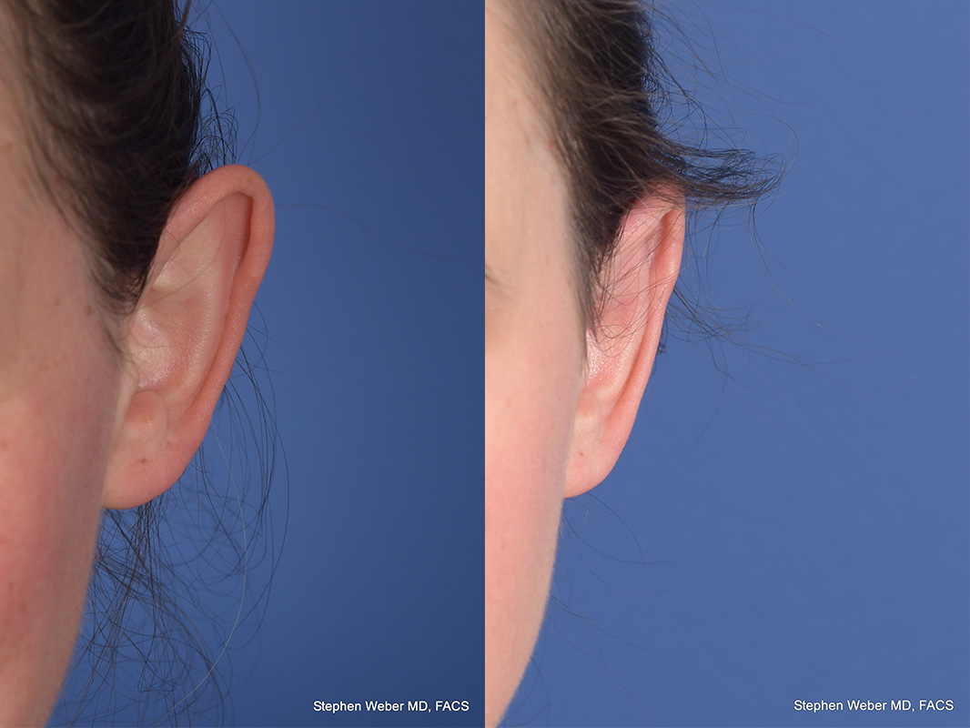 Otoplasty Before and After | Weber Facial Plastic Surgery