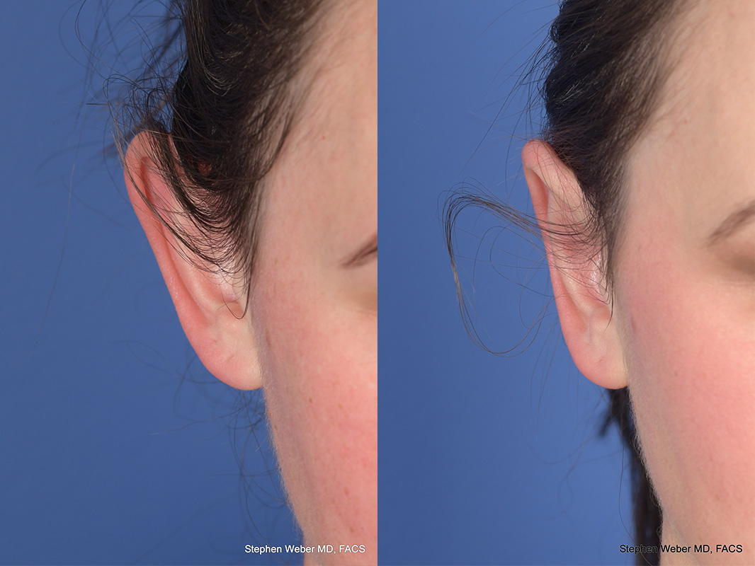 Otoplasty Before and After | Weber Facial Plastic Surgery