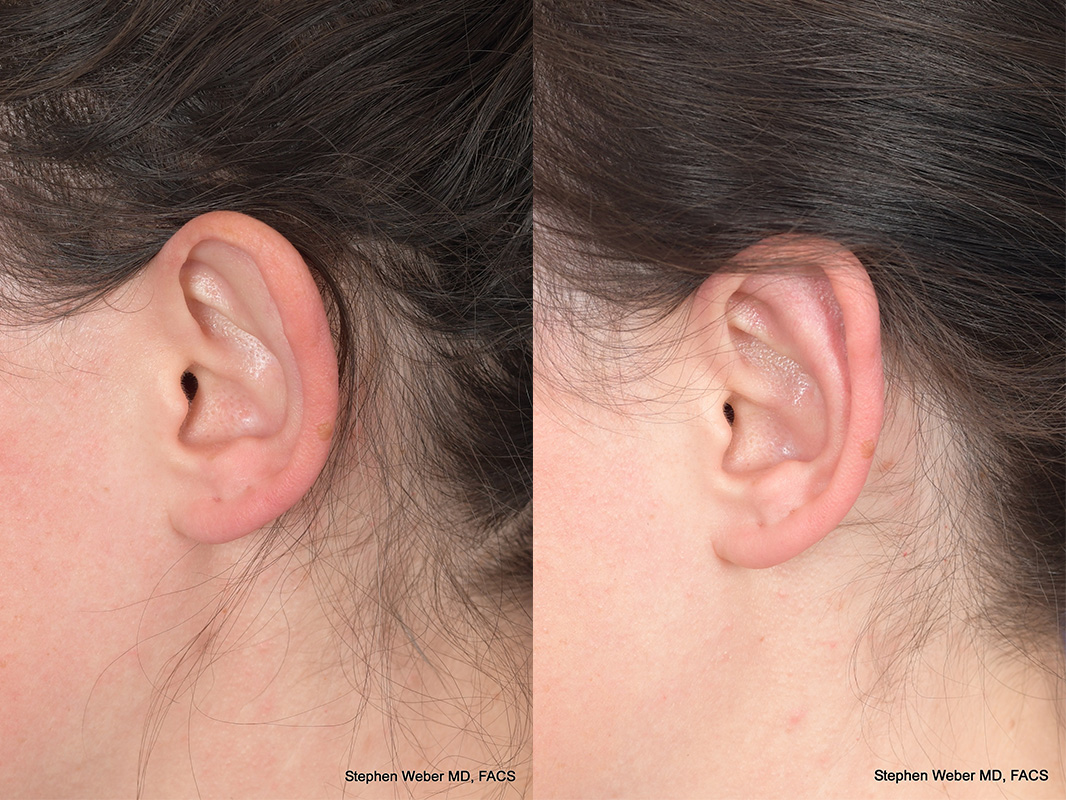 Otoplasty Before and After | Weber Facial Plastic Surgery