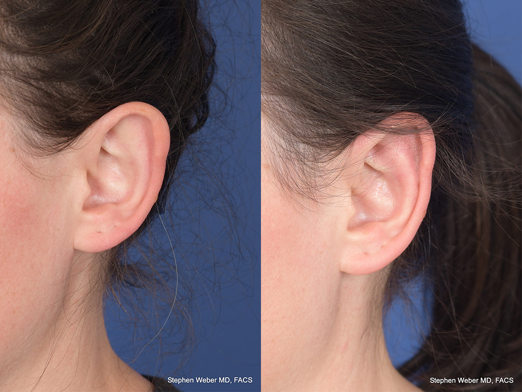 Otoplasty Before and After | Weber Facial Plastic Surgery