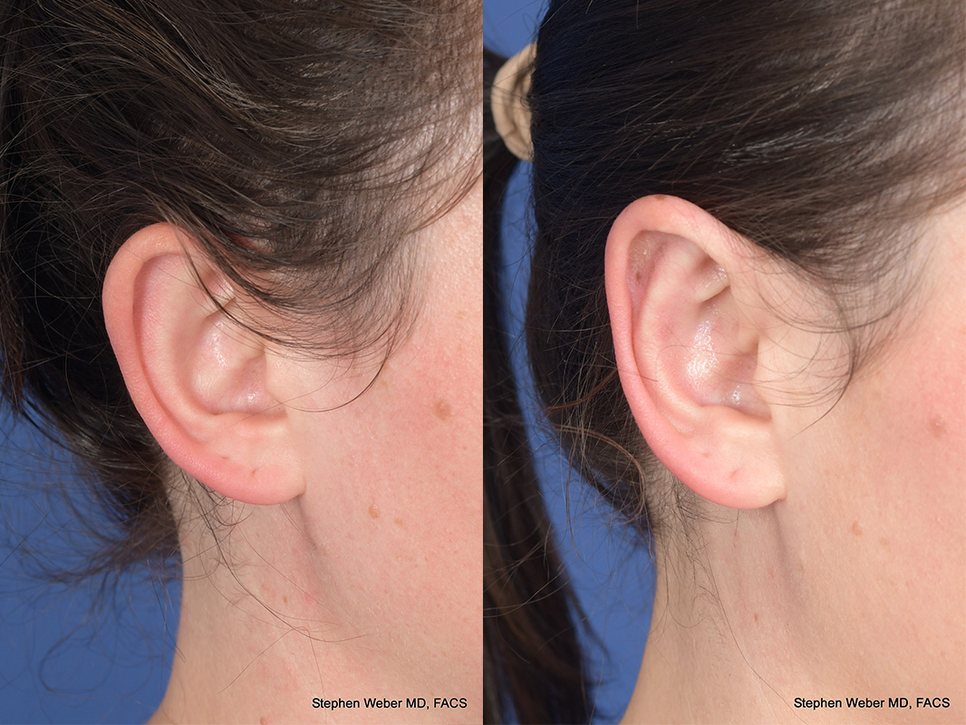 Otoplasty Before and After | Weber Facial Plastic Surgery