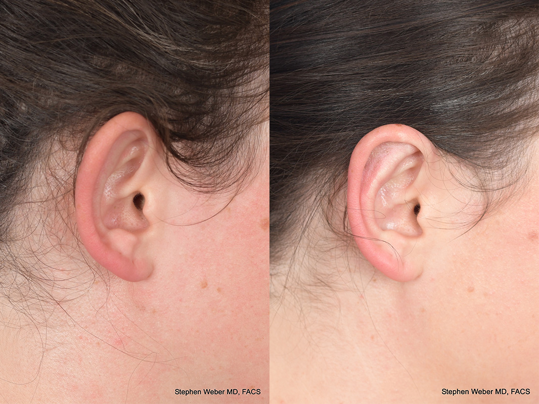 Otoplasty Before and After | Weber Facial Plastic Surgery
