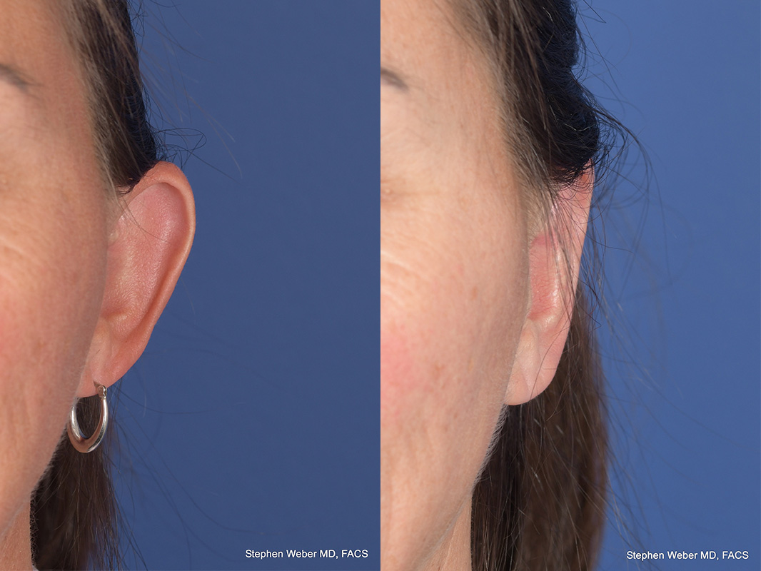 Otoplasty Before and After | Weber Facial Plastic Surgery