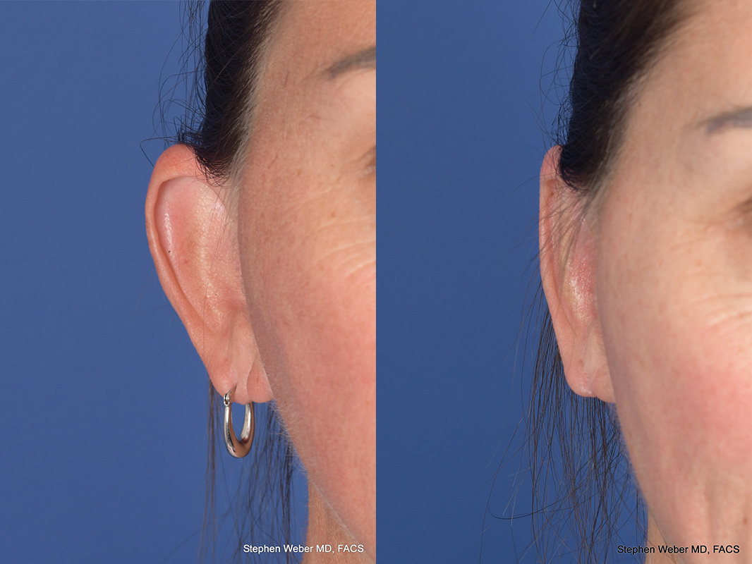 Otoplasty Before and After | Weber Facial Plastic Surgery