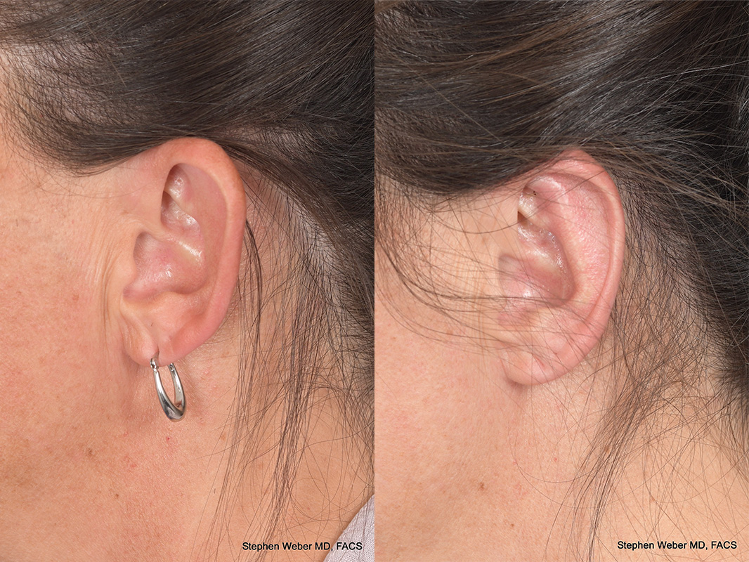 Otoplasty Before and After | Weber Facial Plastic Surgery