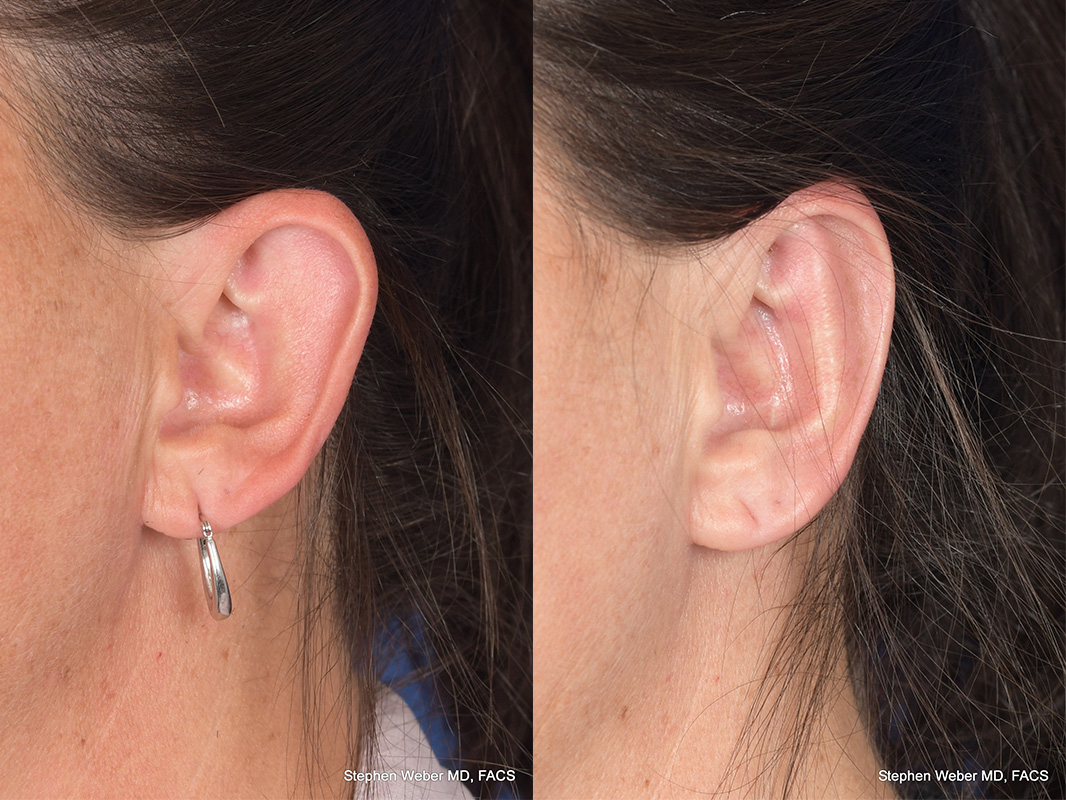 Otoplasty Before and After | Weber Facial Plastic Surgery
