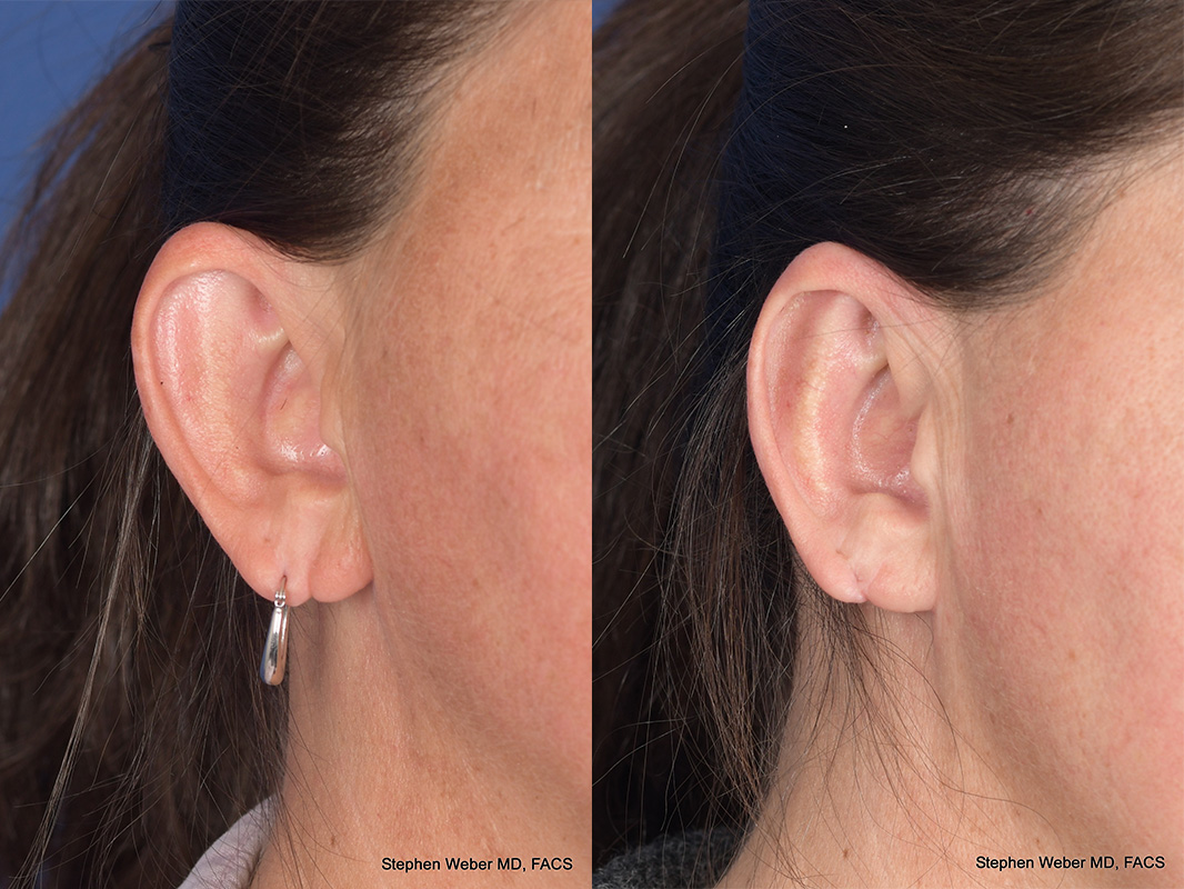 Otoplasty Before and After | Weber Facial Plastic Surgery