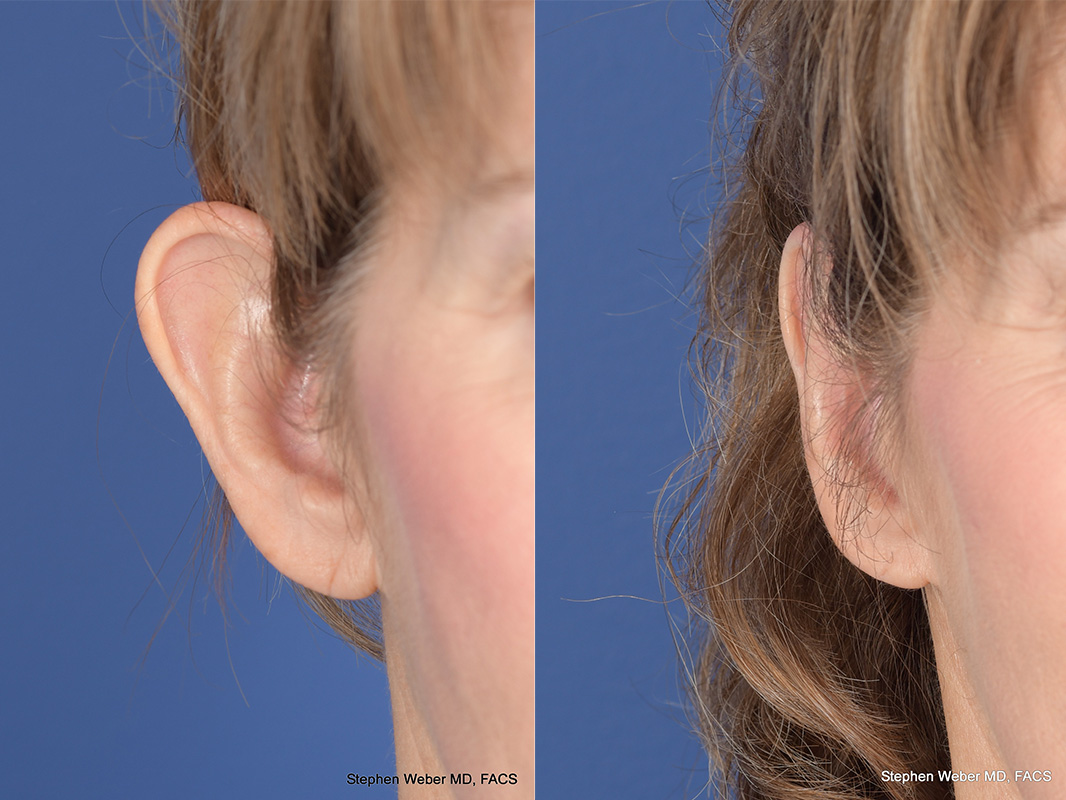 Otoplasty Before and After | Weber Facial Plastic Surgery