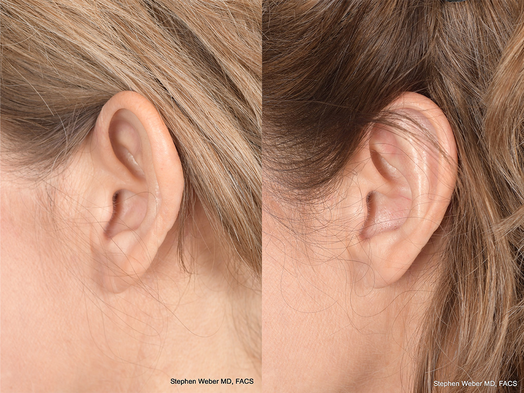 Otoplasty Before and After | Weber Facial Plastic Surgery