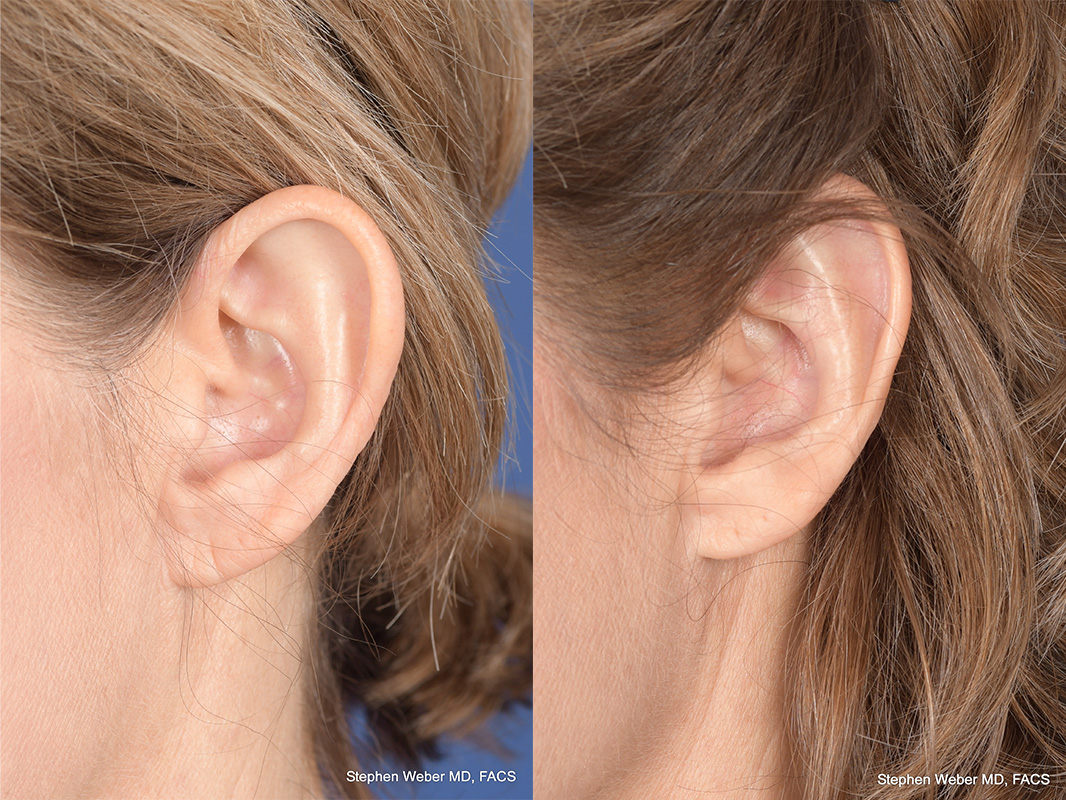 Otoplasty Before and After | Weber Facial Plastic Surgery
