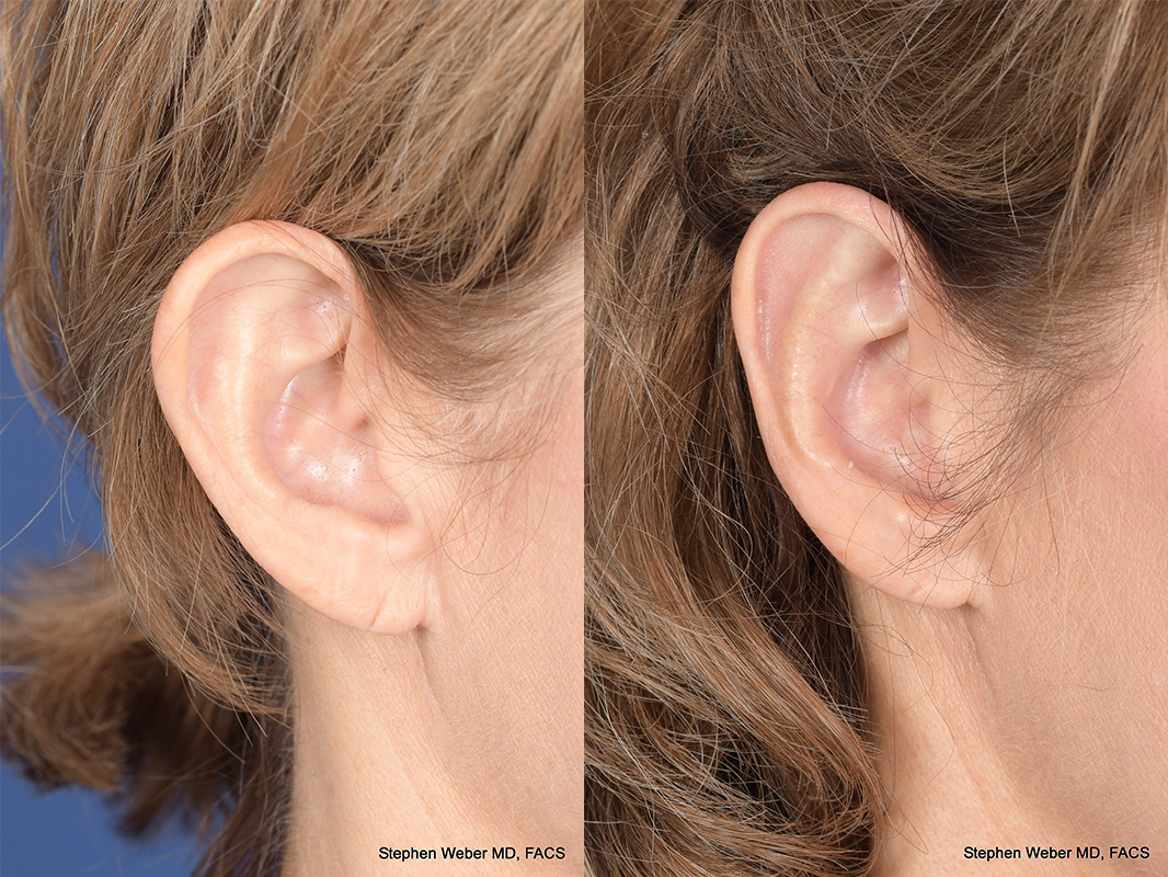 Otoplasty Before and After | Weber Facial Plastic Surgery