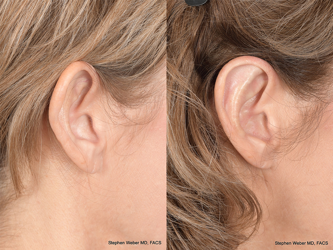 Otoplasty Before and After | Weber Facial Plastic Surgery