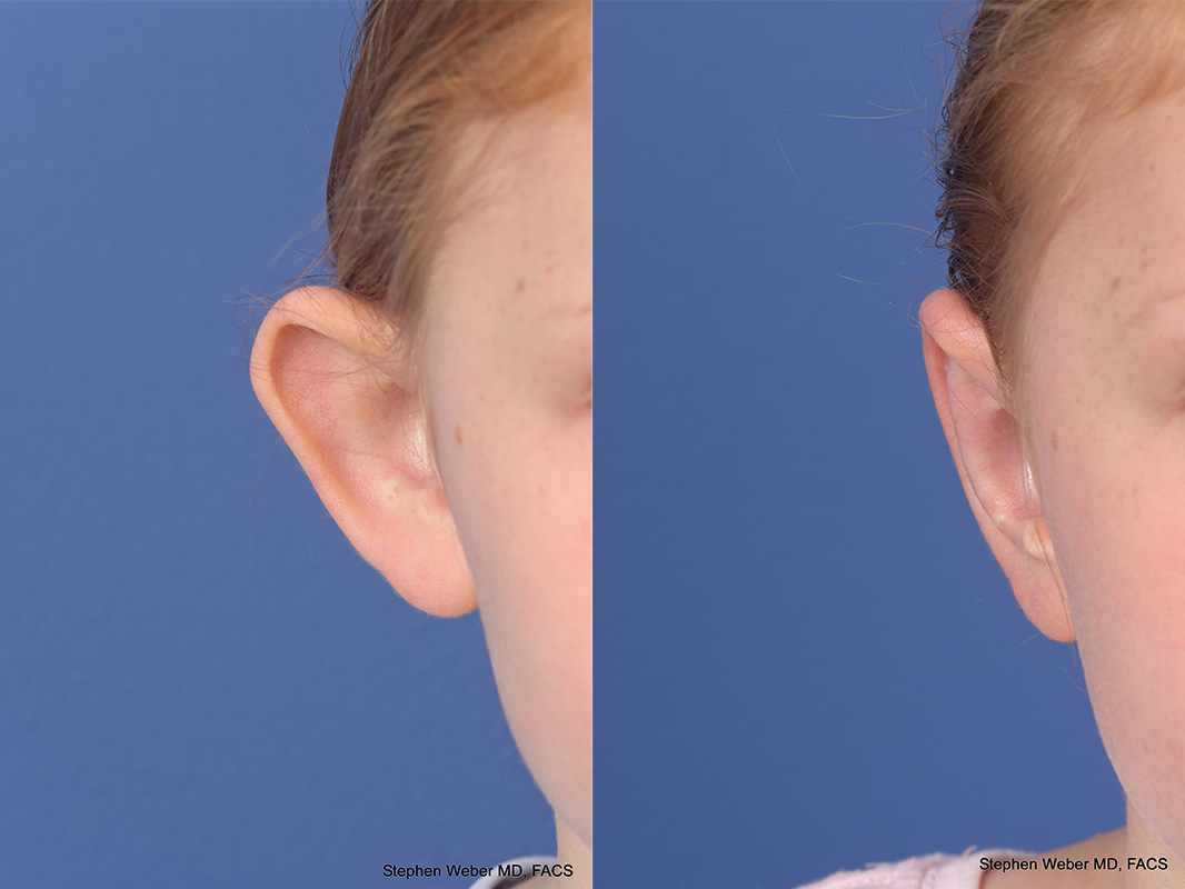 Otoplasty Before and After | Weber Facial Plastic Surgery