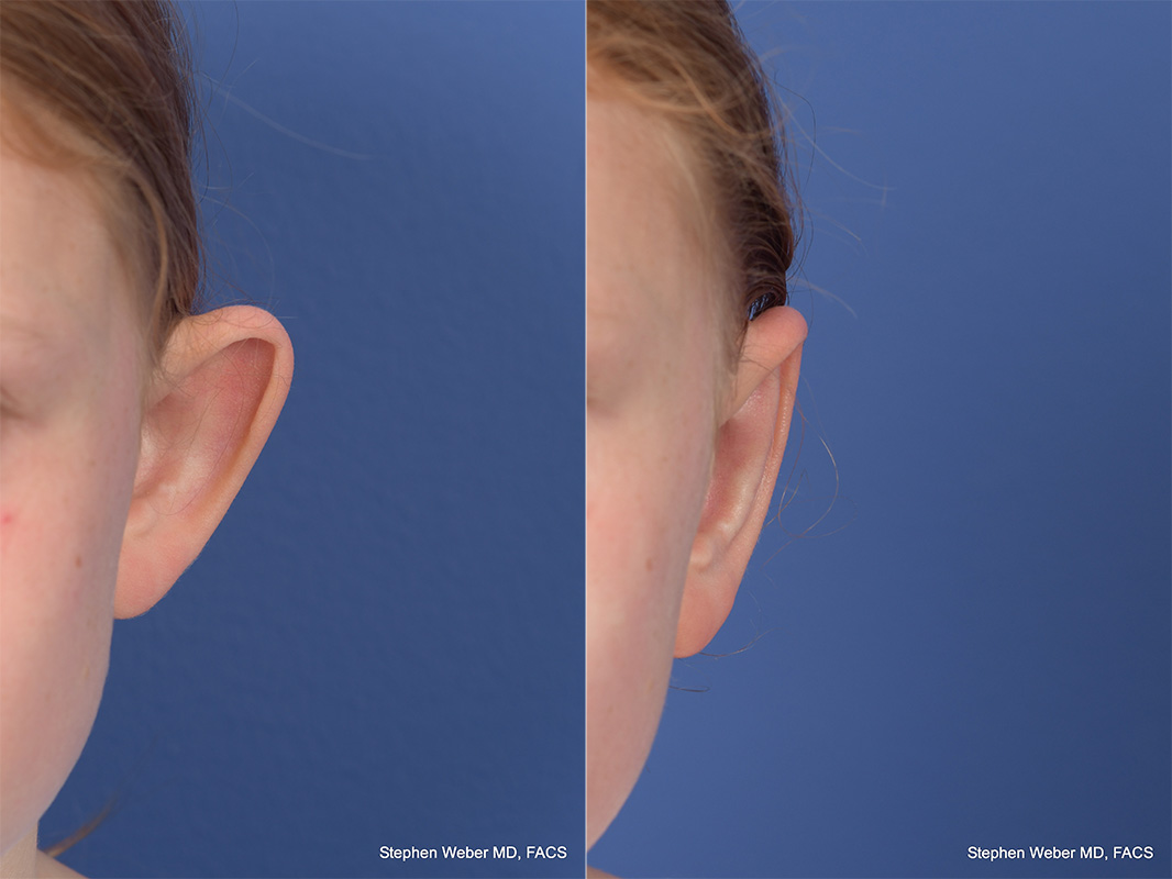 Otoplasty Before and After | Weber Facial Plastic Surgery