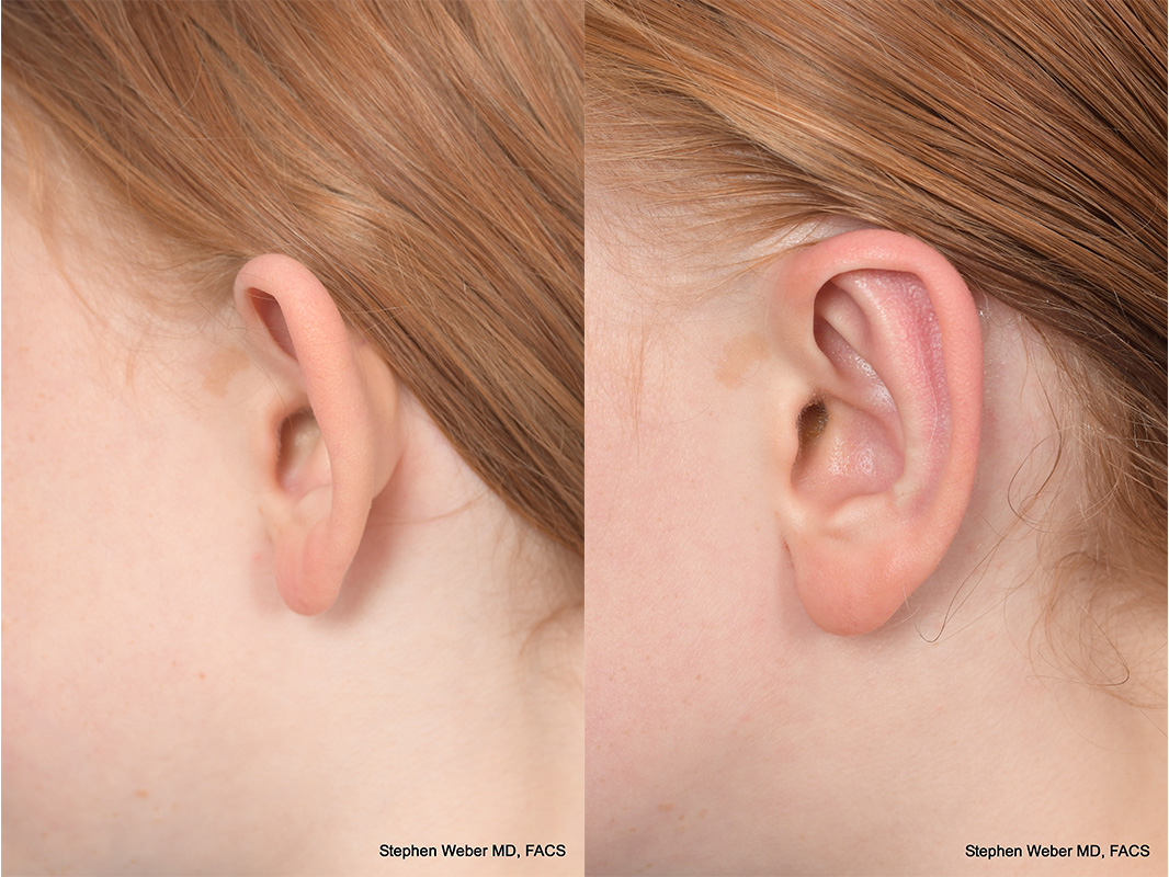 Otoplasty Before and After | Weber Facial Plastic Surgery