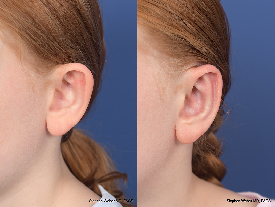 Otoplasty Before and After | Weber Facial Plastic Surgery