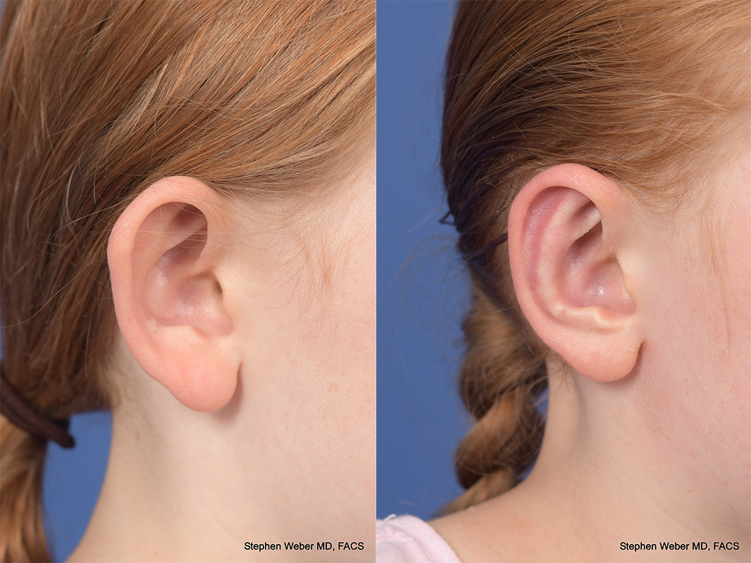 Otoplasty Before and After | Weber Facial Plastic Surgery