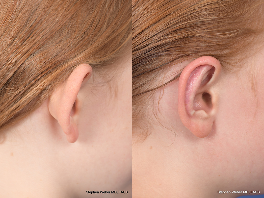 Otoplasty Before and After | Weber Facial Plastic Surgery