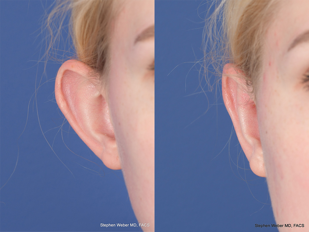 Otoplasty Before and After | Weber Facial Plastic Surgery