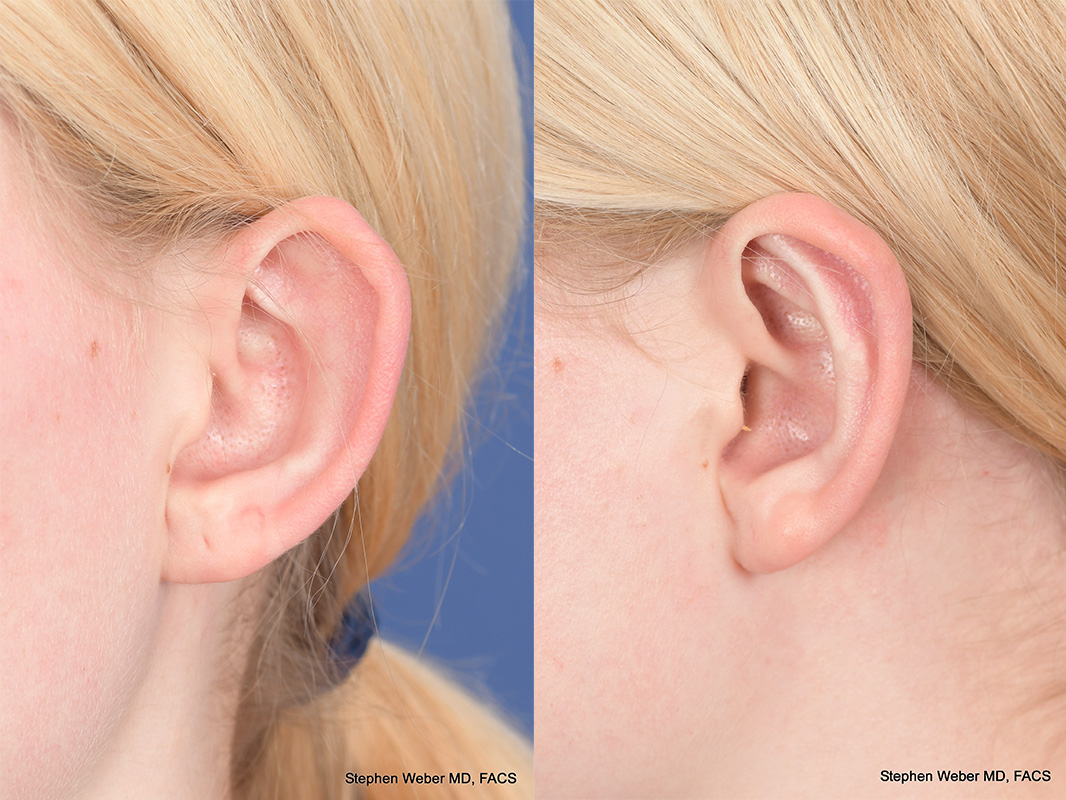 Otoplasty Before and After | Weber Facial Plastic Surgery
