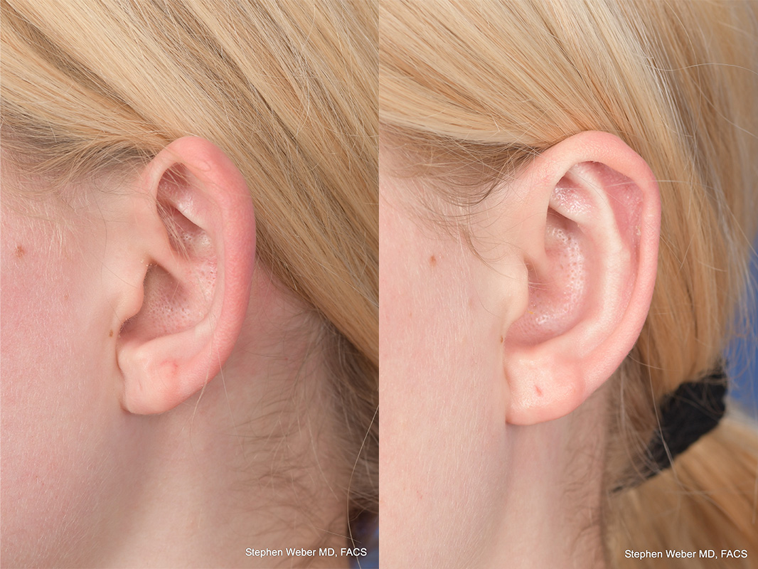 Otoplasty Before and After | Weber Facial Plastic Surgery