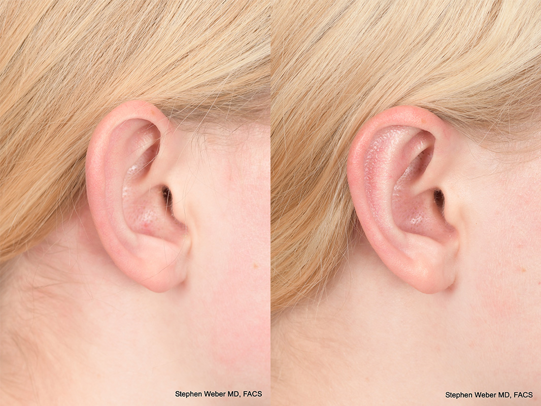 Otoplasty Before and After | Weber Facial Plastic Surgery