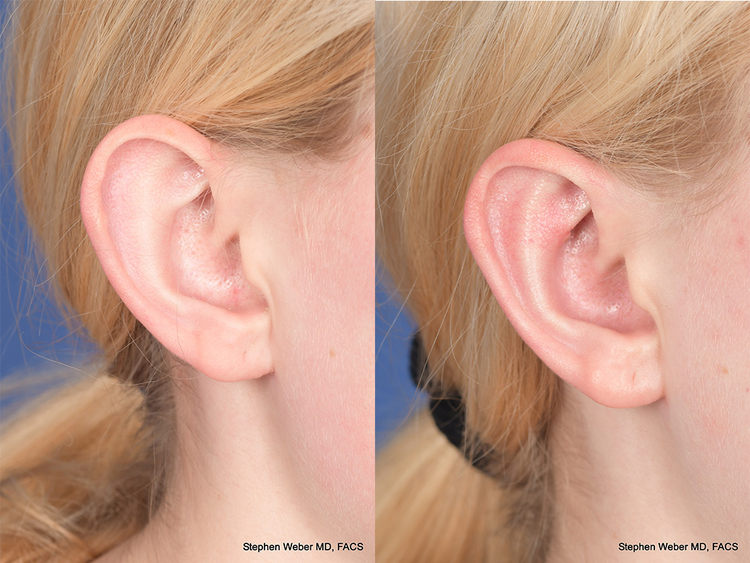 Otoplasty Before and After | Weber Facial Plastic Surgery
