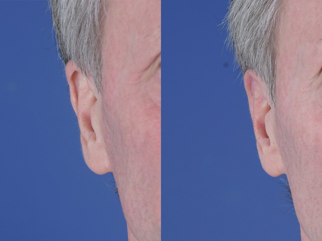 Otoplasty Before and After | Weber Facial Plastic Surgery