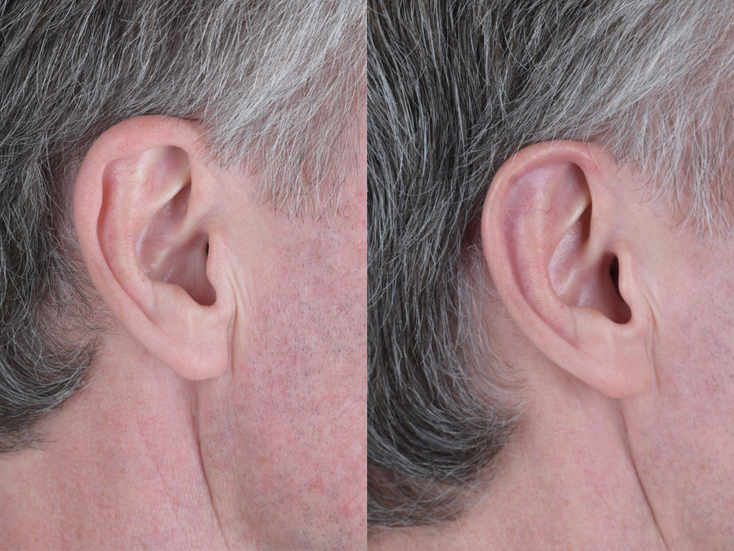 Otoplasty Before and After | Weber Facial Plastic Surgery